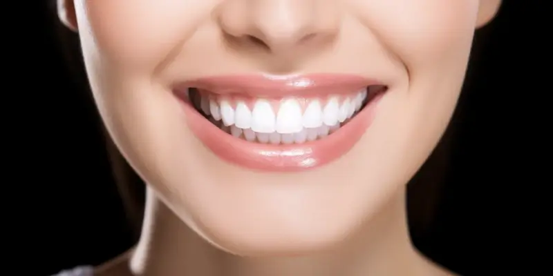 Licówki jak wyglądają?