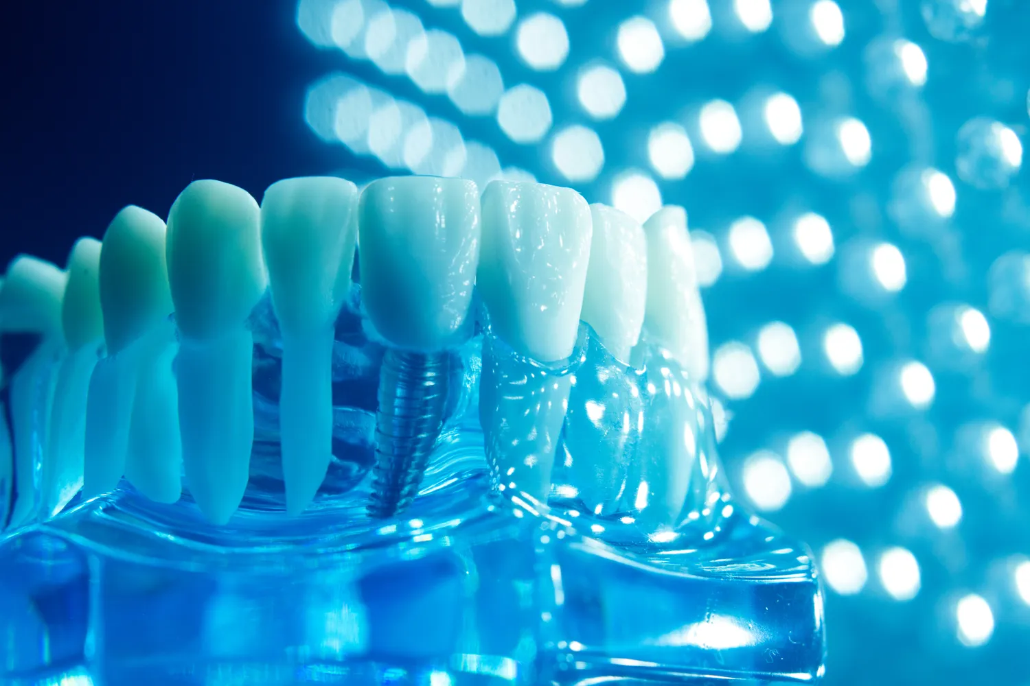 Implanty stomatologiczne Lublin